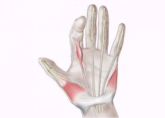 التهاب الأوتار كسبب للألم في مفاصل الأصابع