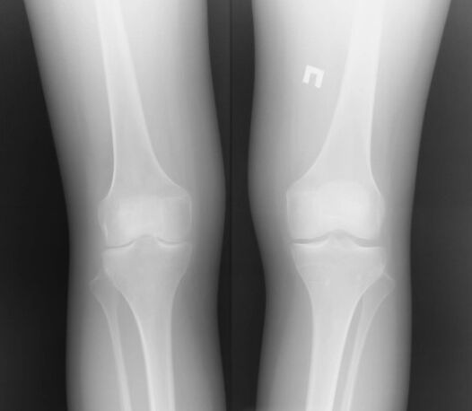 صورة X -Ray لمفصل الركبة