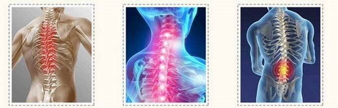 آفات العمود الفقري العظمي