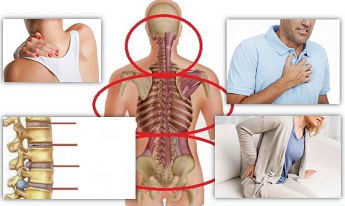 مواقع المرض لتصلب العظم