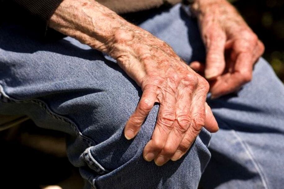 هشاشة العظام هو مرض مرتبط بالعمر يحدث عند كبار السن